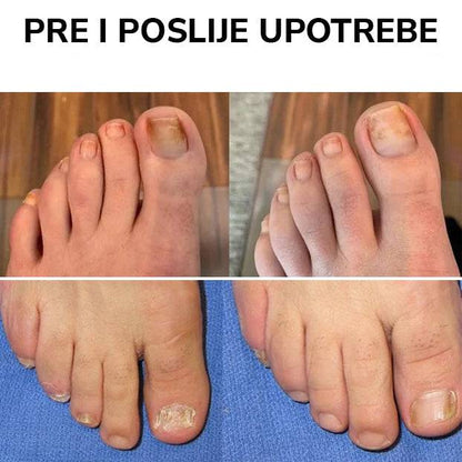 Kapi za borbu protiv gljivica - BESPLATNA POŠTARINA
