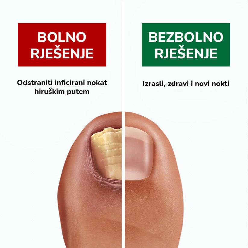 Kapi za borbu protiv gljivica - BESPLATNA POŠTARINA